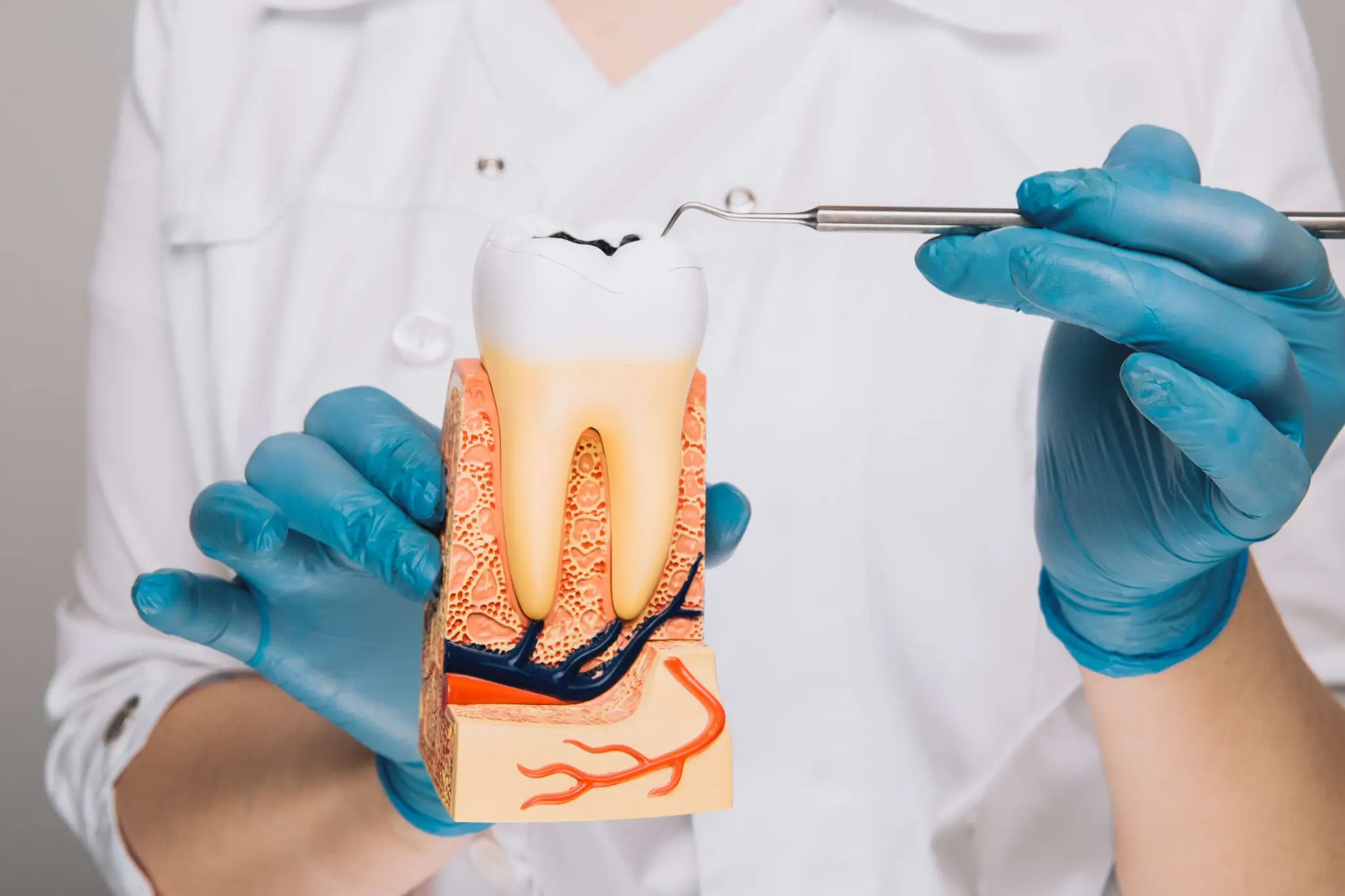 Root Canal Therapy