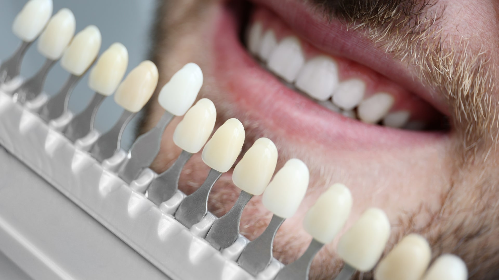 Veneers